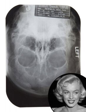 Marilyn Monroe, Plastic Surgery, X-Ray, Auction Marilyn Monroe, Plastic Surgery, X-Ray, Auction