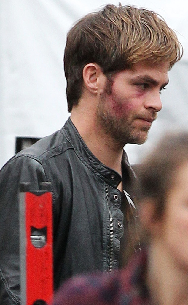 Chris Pine, Horrible Bosses 2, Bruises Chris Pine, Horrible Bosses 2, Bruises