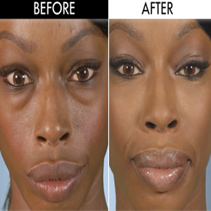 botched sex reassignment surgery botched sex reassignment surgery