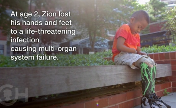 Zion Harvey, Hand Transplant Zion Harvey, Hand Transplant