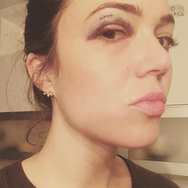 Mandy Moore, Black Eye Mandy Moore, Black Eye