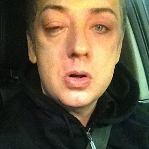 Boy George Suffers Black Eye After Nasty Nightclub Attack - E! Online
