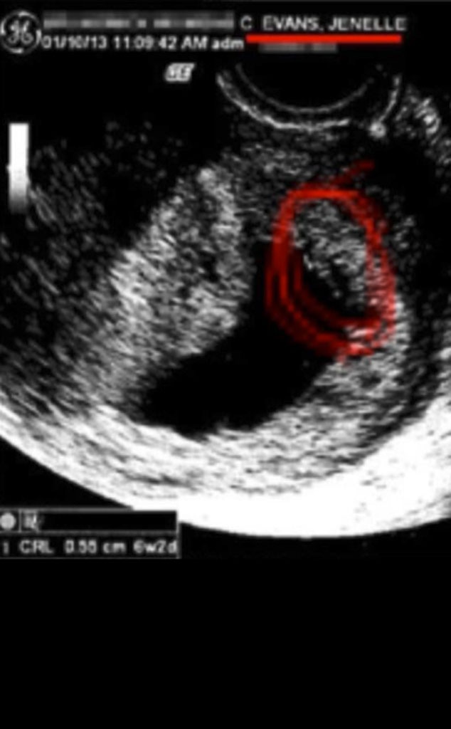 Janelle Evans, Ultrasound, Twit Pic