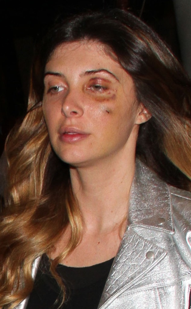 Brittny Gastineau Steps Out With Black Eye, Files Police Report ...