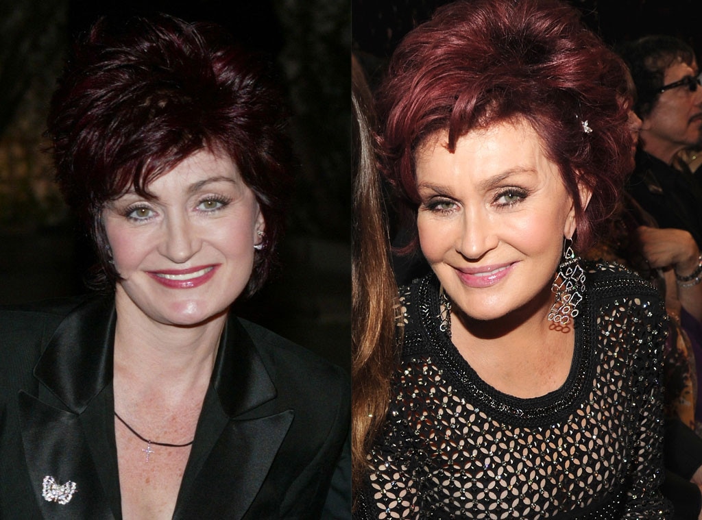 Sharon Osbourne, Plastic Surgery, Before and After
