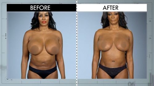 Boobs jobs before and after