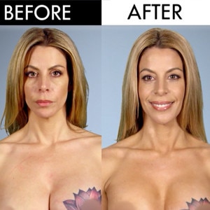 Botched Before And After: Breast Cancer Survivor Gets Her Wish | E! News