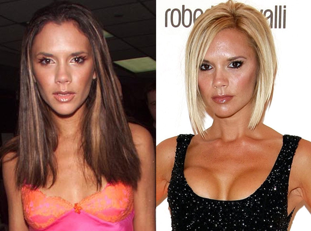 Victoria Beckham, Plastic Surgery