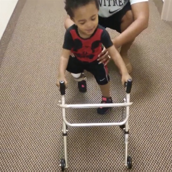 Adorable 2YearOld Walks for First Time After Amputations