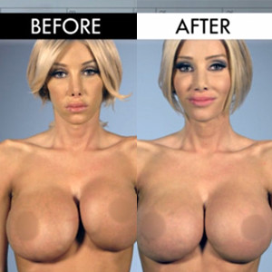 See The Mind Blowing Before And After Pics Of Botched Patients E News 3212