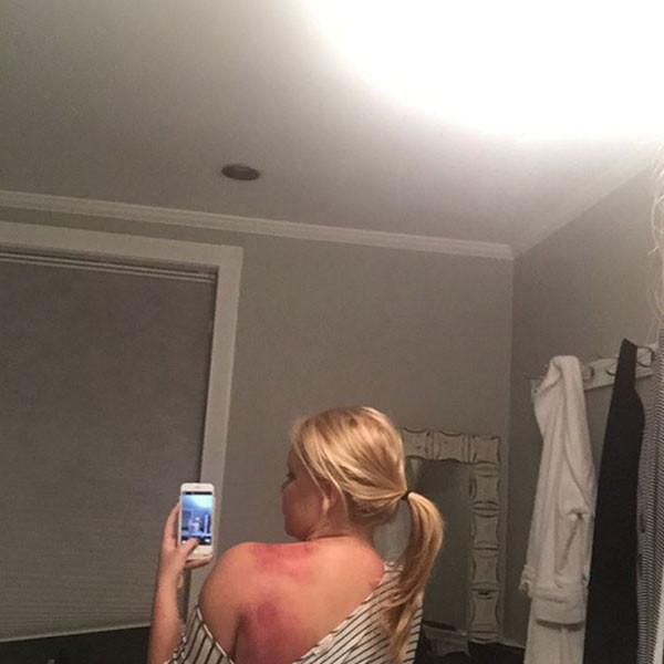 Amy Schumer Shows Off Nasty Back Bruise - E! Online