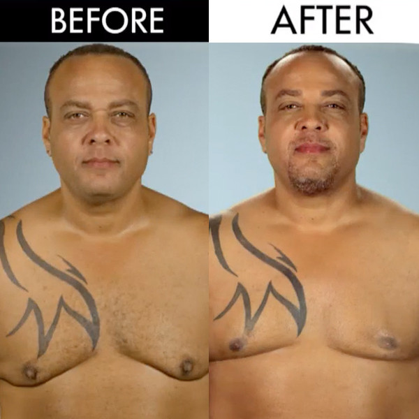 Man Boobs And Butt Implants See The Botched Before And Afters