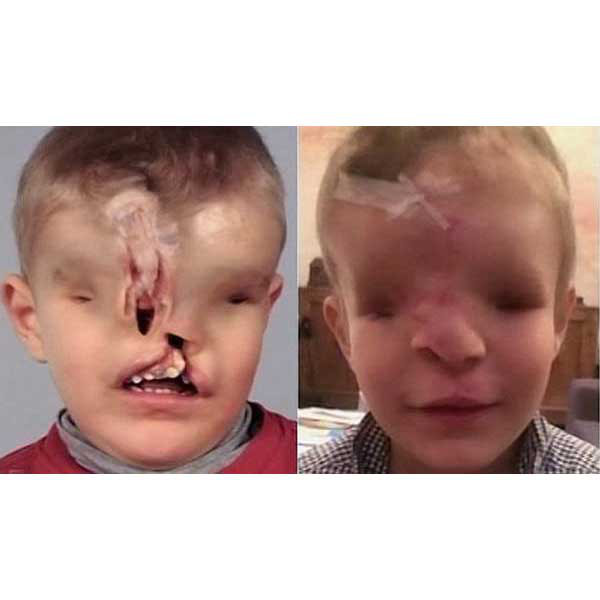 This 3-Year-Old Boy Just Had the Biggest Surgery of His Life - E! Online