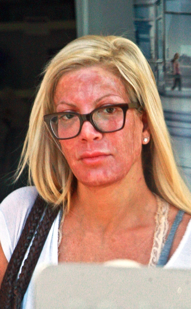 Tori Spelling, Chemical Peel