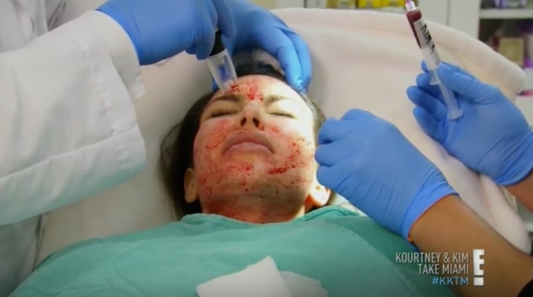 Kim Kardashian, Vampire Facial