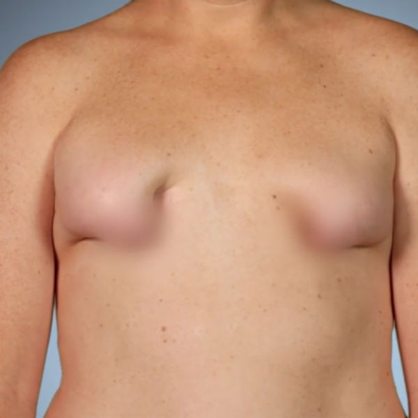 туберозное заболевание груди у женщин фото 73