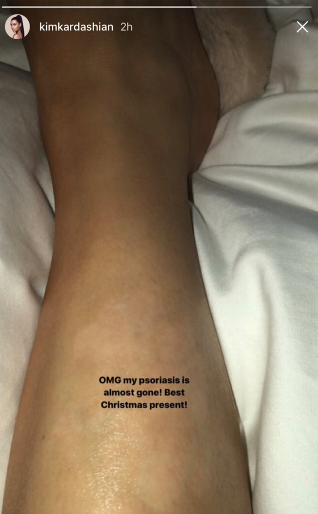 Kim Kardashian, Psoiasis