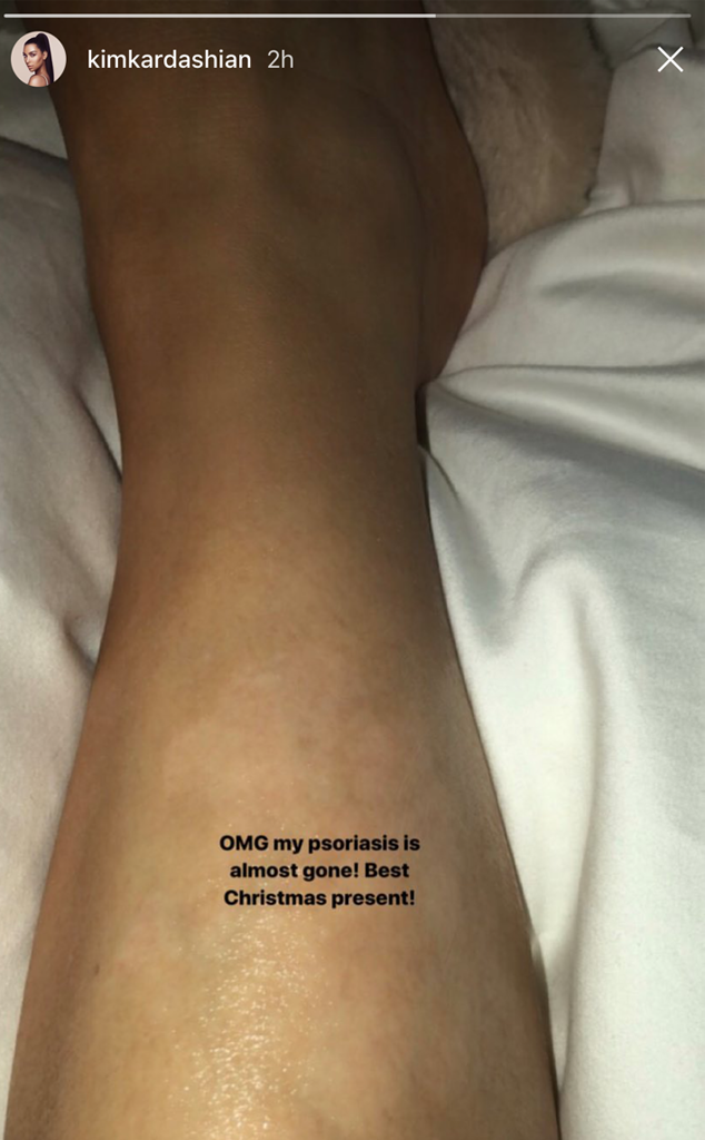 Kim Kardashian Reveals Her Psoriasis Is Almost Completely ... - 634 x 1024 png 1045kB