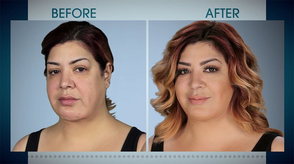 A Chopped Chin from Botched Patients Before and After: Shocking ...