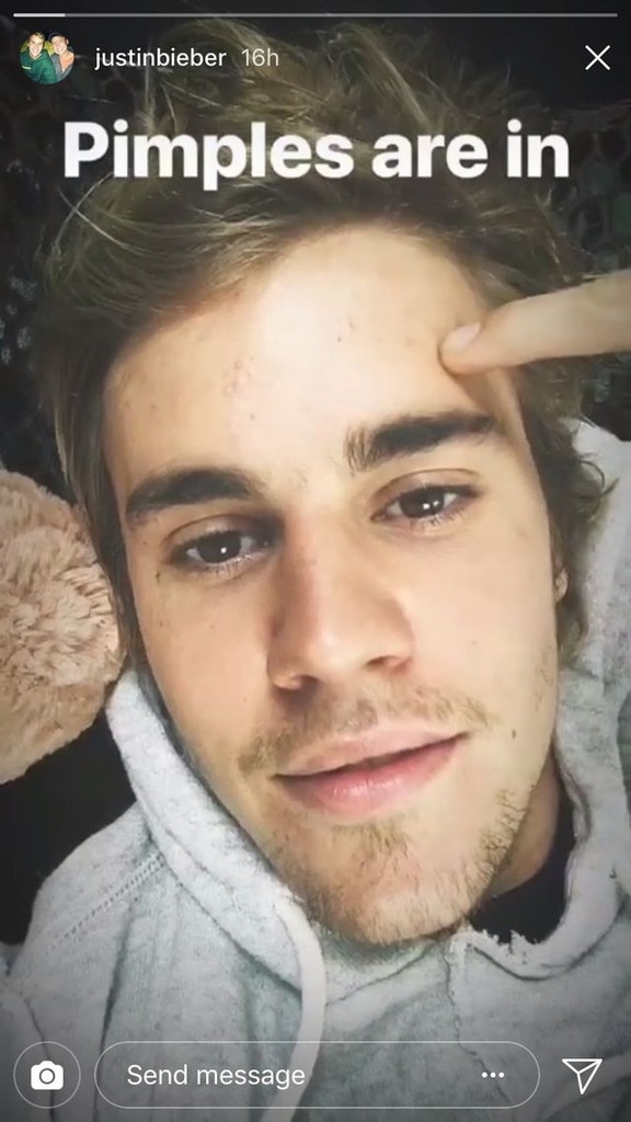 Justin Bieber from Celebs Who Embrace Their Blemishes | E! News