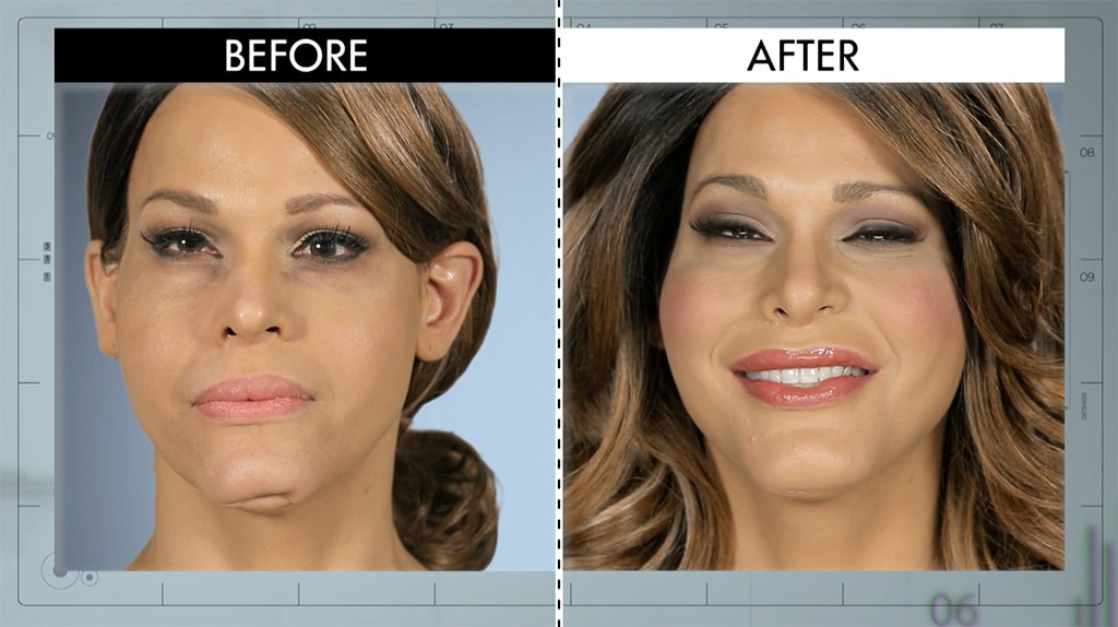 Dented Chin from Botched Patients Before and After: Shocking ...