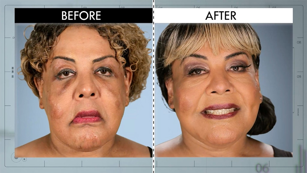 Sagging Face From Botched Patients Before And After Shocking