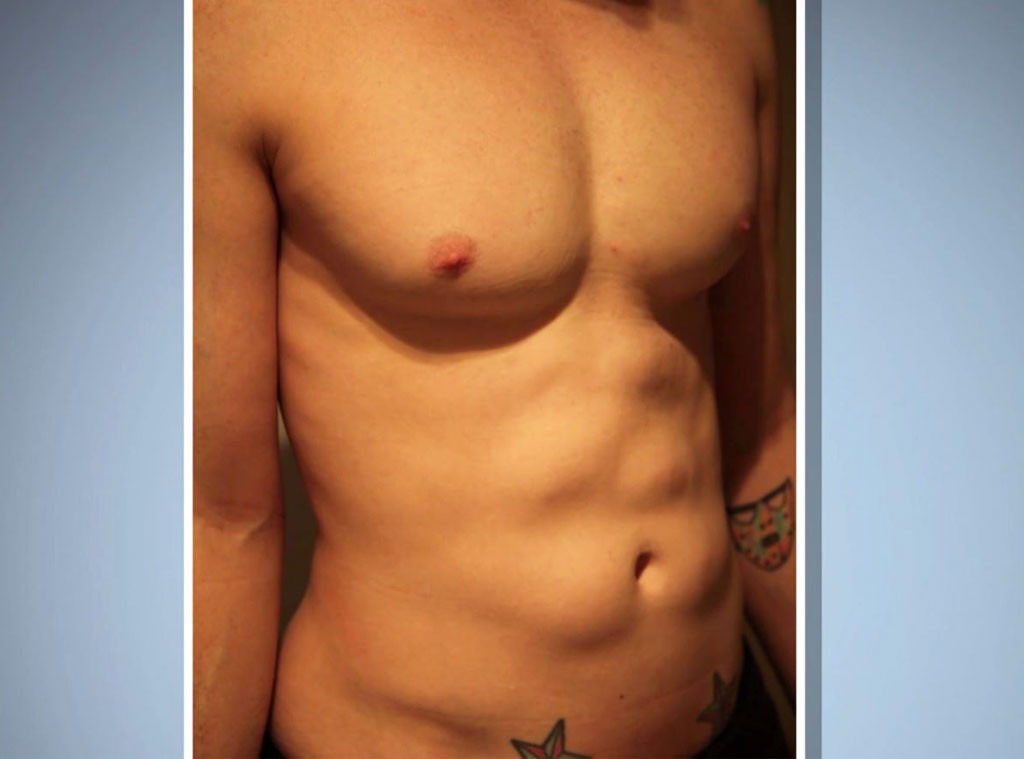 Detox, Botched 419