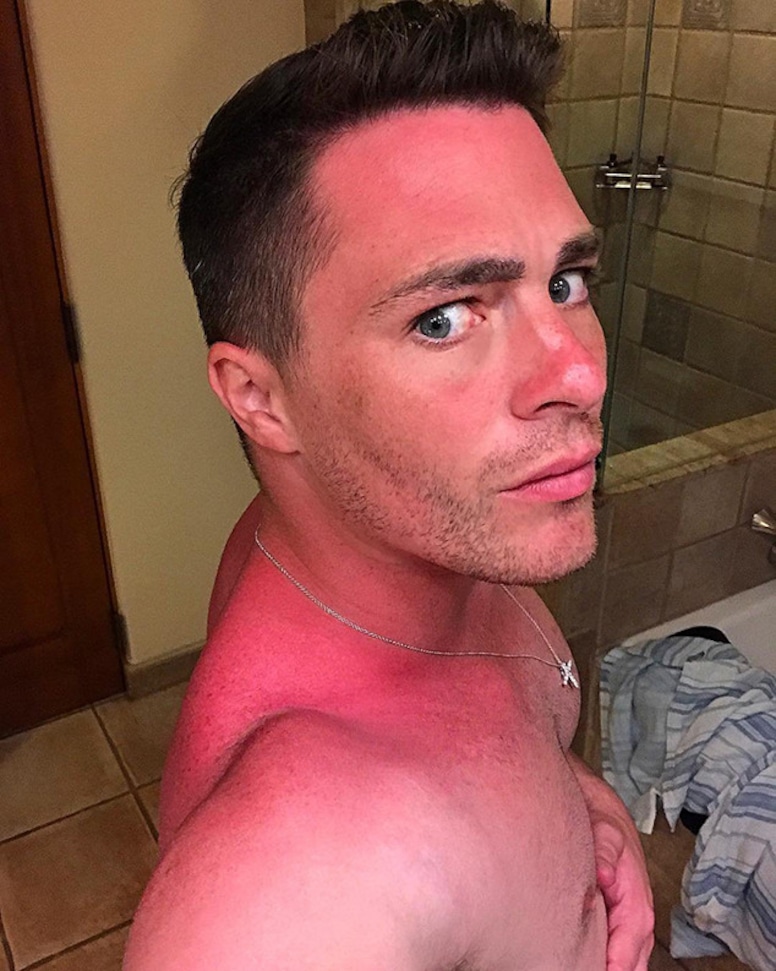 Colton Haynes, Sunburn