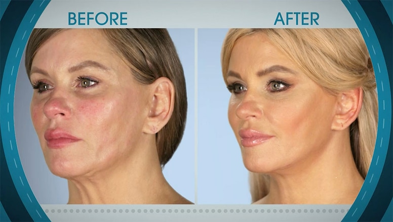 Botched 605, Before & After