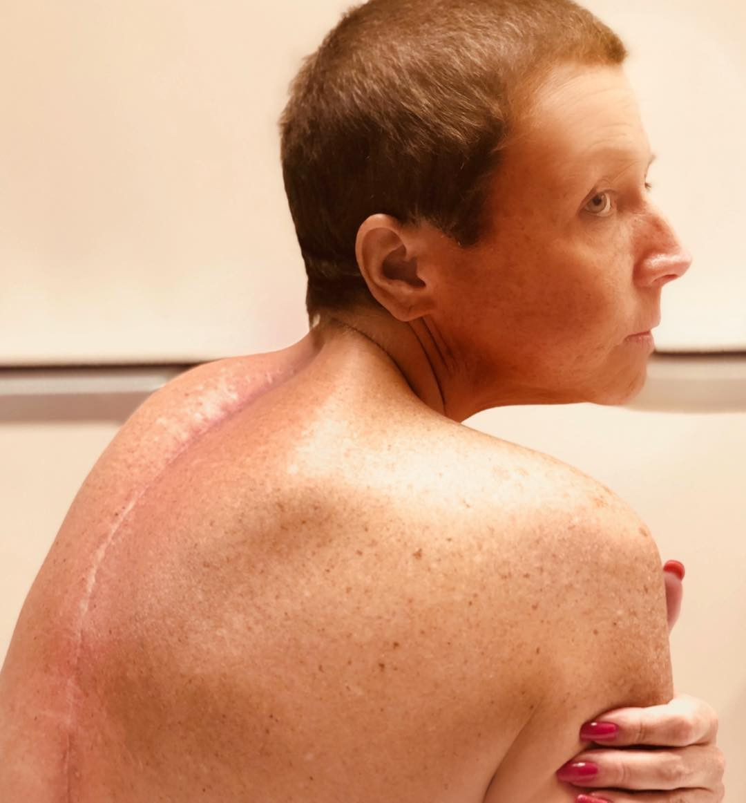 Abby Lee Miller Reveals Spinal Scar On 1 Year Anniversary Of Surgery E Online