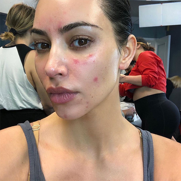 Kim Kardashian Shared Videos of Her 'Painful' Psoriasis Flare-Up