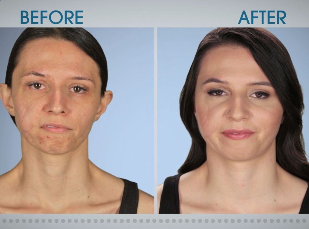 Cheeky But Not Smiling From Botched Patients Before And After Shocking Transformations E News 4147