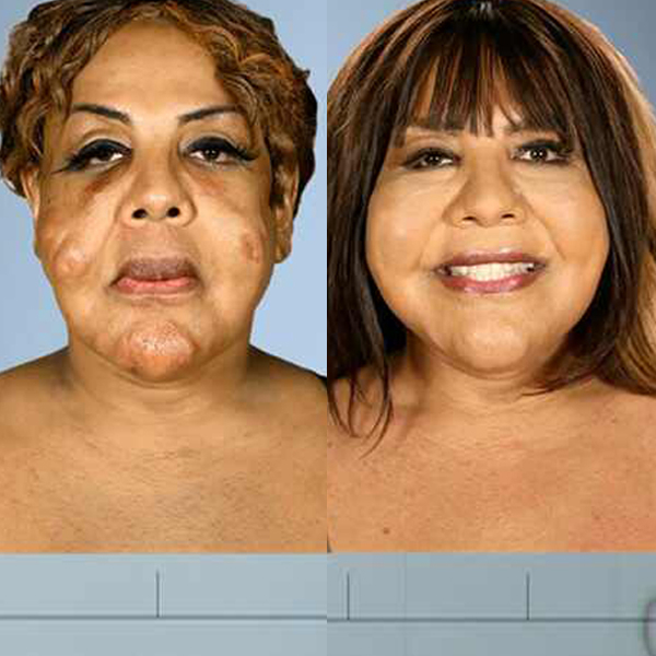 Photos from Botched Patients Before and After: Shocking Transformations! -  Page 3