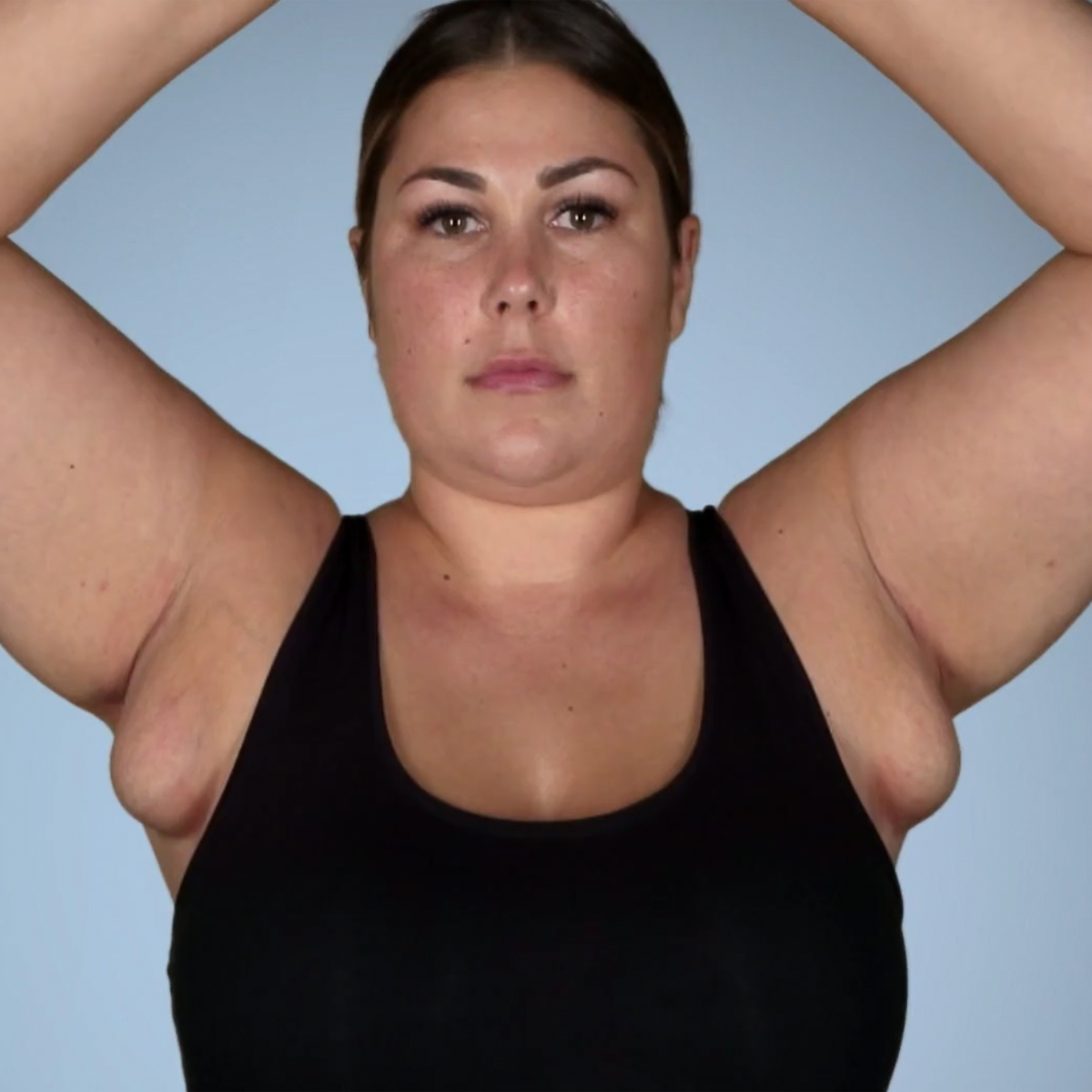 Botched Patient With Milk-Leaking Armpit Boobs Gets a Breast Reduction Like  You've Never Seen