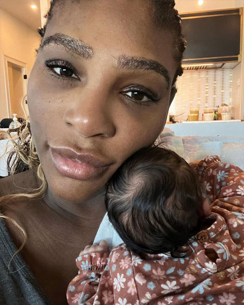 Serena Williams Shares Breastmilk Helped Treat the Sunburn on Her Face