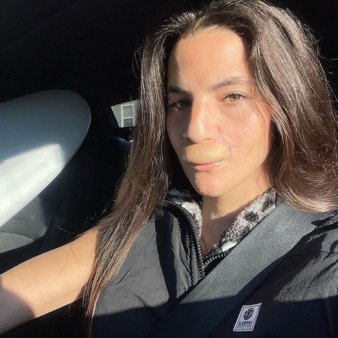 Pro Skateboarder Brooklinn Khoury Shares Lip Reconstruction Progress 3 Years Pro Skateboarder Brooklinn Khoury Shares Lip Reconstruction Progress 3 Years