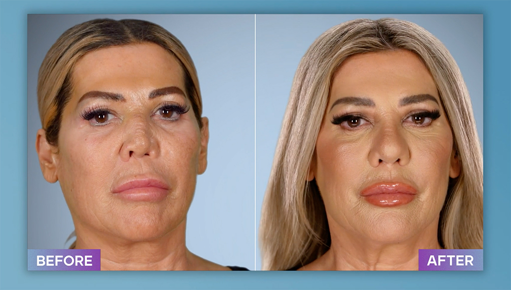 Photos from Botched Patients Before and After: Shocking Transformations! -  Page 2