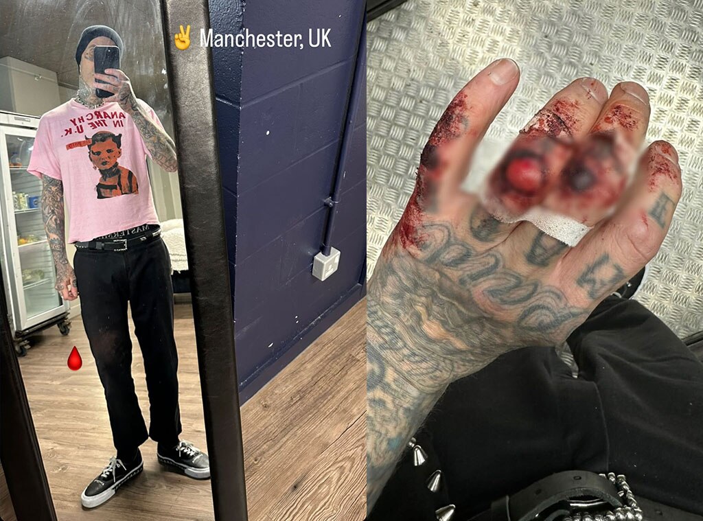 Travis Barker Shares Pic of Gruesome Hand Injury After Blink 182 Show