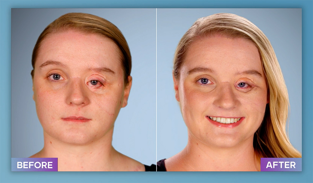 Photos from Botched Patients Before and After: Shocking Transformations!