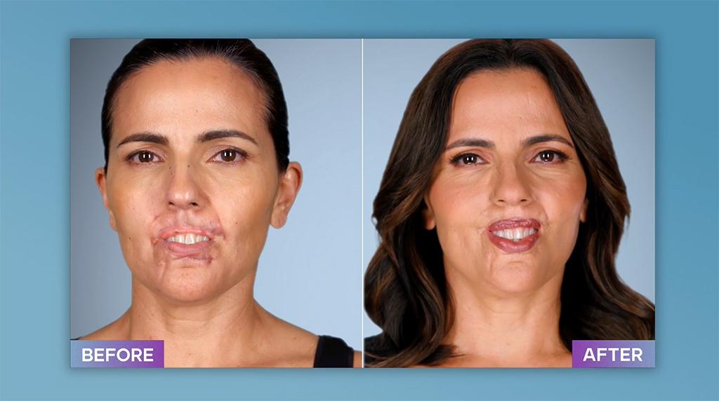 Photos from Botched Patients Before and After: Shocking