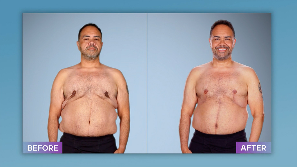 Botched:Tummy Tuck Plastic Surgery Gone Wrong fixed by Dr. Placik