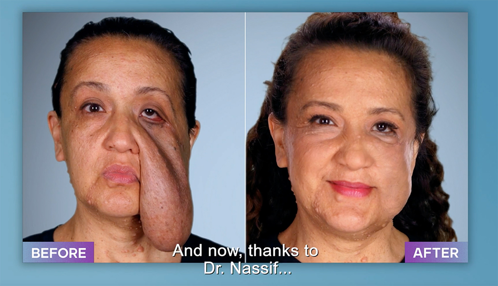Botched Patients Before and After: Shocking Transformations!