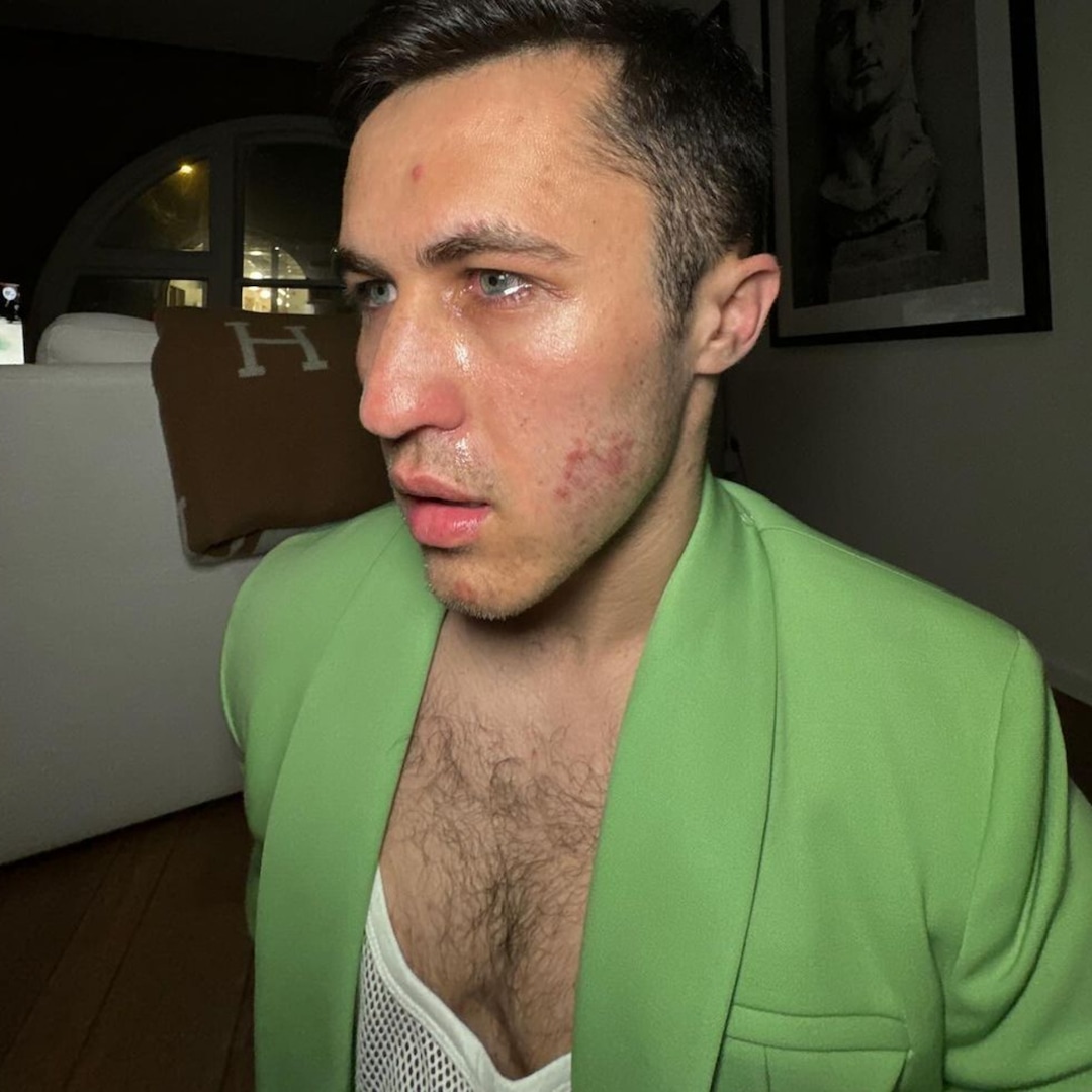 изчиства ефира относно неговата диагноза трихофития TikToker разказа подробно как наскоро