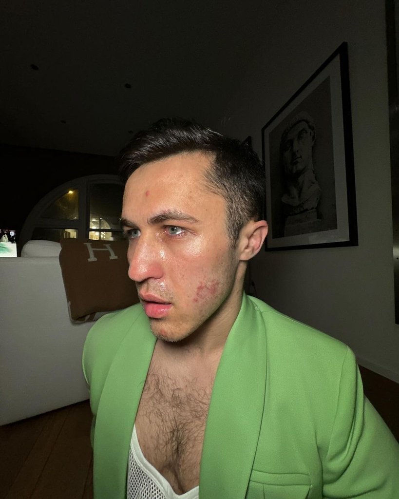 celebrities with ringworm