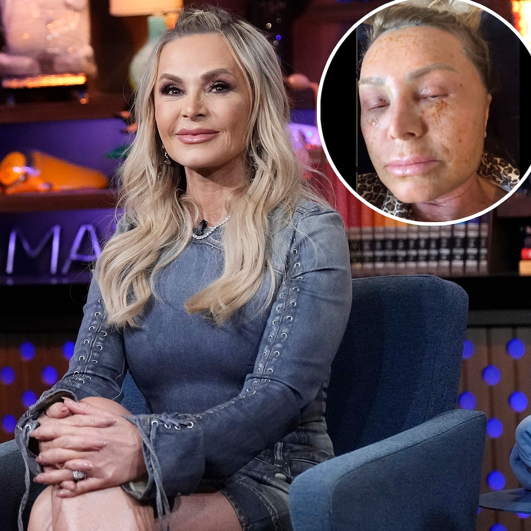 Real Housewives’ Tamra Judge Looks Unrecognizable as She Shows Results of Extreme Cosmetic Procedure – E! Online Real Housewives’ Tamra Judge Looks Unrecognizable as She Shows Results of Extreme Cosmetic Procedure – E! Online
