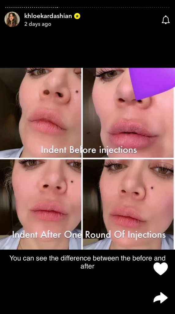 Khloe Kardashian Shares Pics of Facial Injections After Removing Tumor