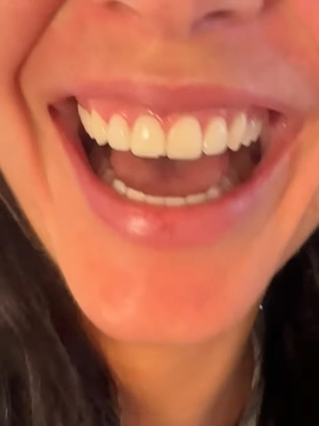 Kendall Jenner's Chipped Tooth