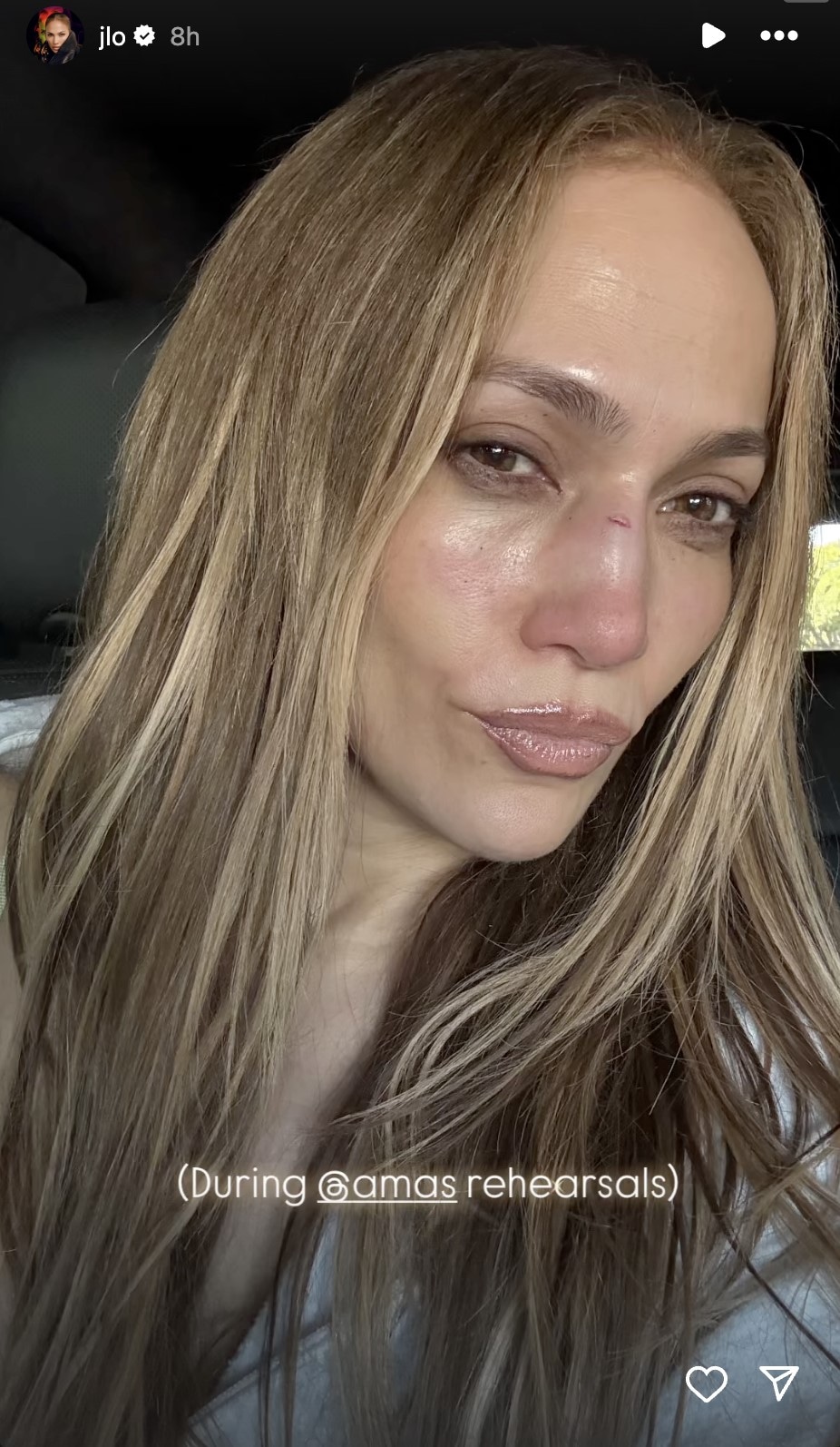 Jennifer Lopez AMAs Injury