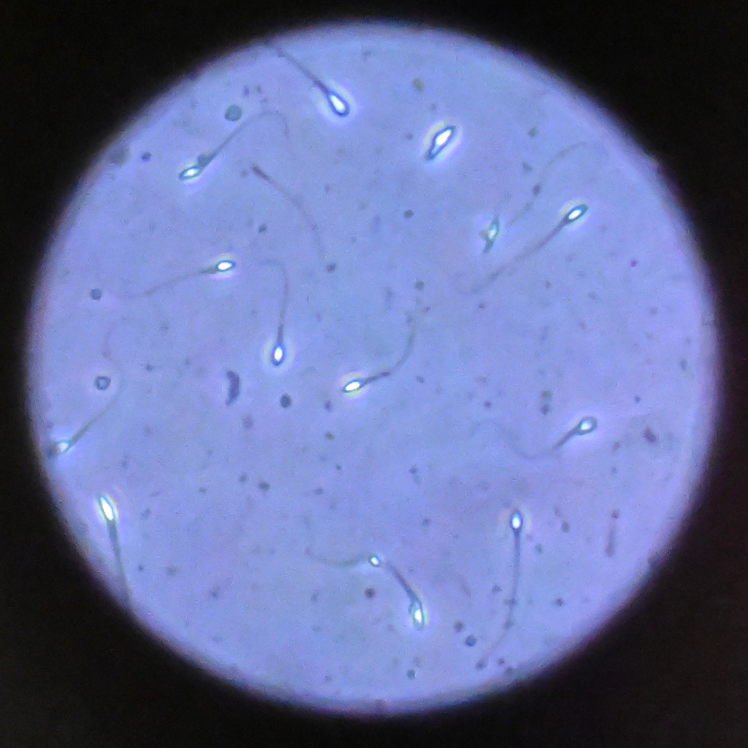 Sperm Donor With Rare Mutation Linked to Cancer Sparks Debate After Fathering 67 Kids Sperm Donor With Rare Mutation Linked to Cancer Sparks Debate After Fathering 67 Kids