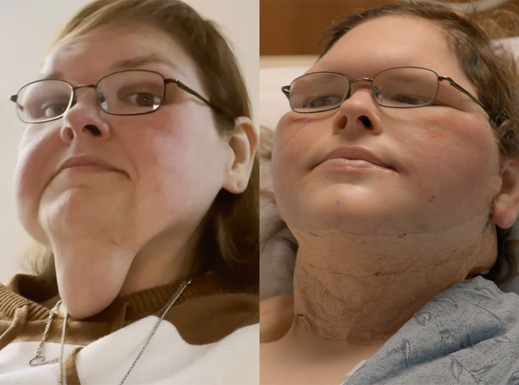 6/10 EMBARGO -- Tammy Slaton, 1000-Lb Sisters, skin removal surgery 